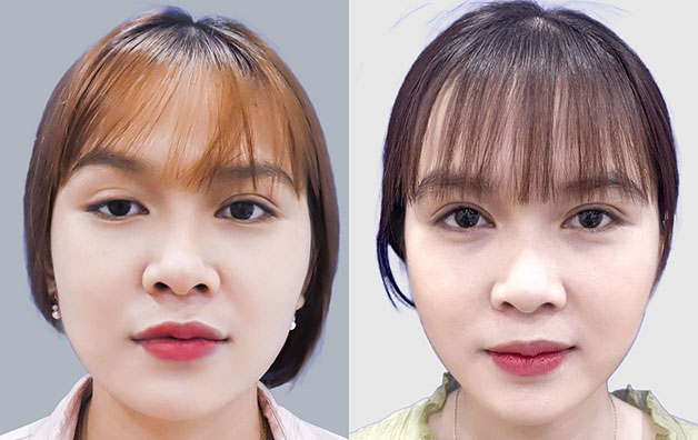 Cắt mắt sụp mí có giá dao động từ 9 - 30 triệu đồng