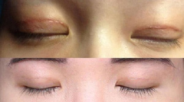 Sau khi cắt chỉ mí mắt từ 5 - 7 ngày, chị nên bôi kem trị sẹo