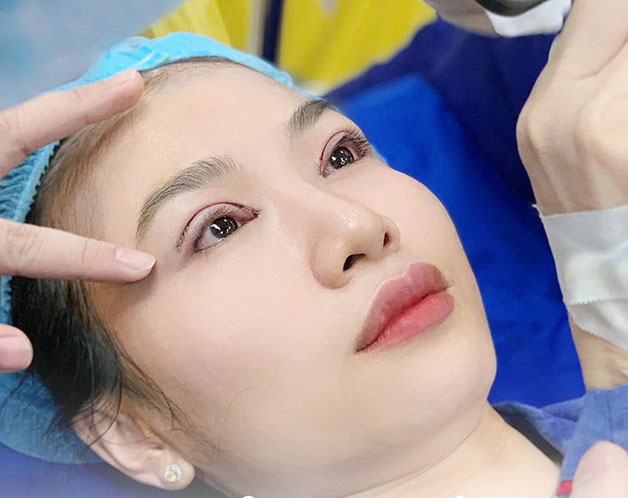 Cắt mí không gây ảnh hưởng đến thị lực