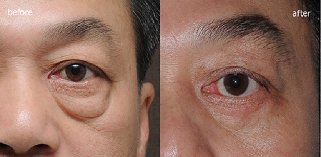 Cắt mí mắt dưới không gây ảnh hưởng đến sức khỏe và thị lực