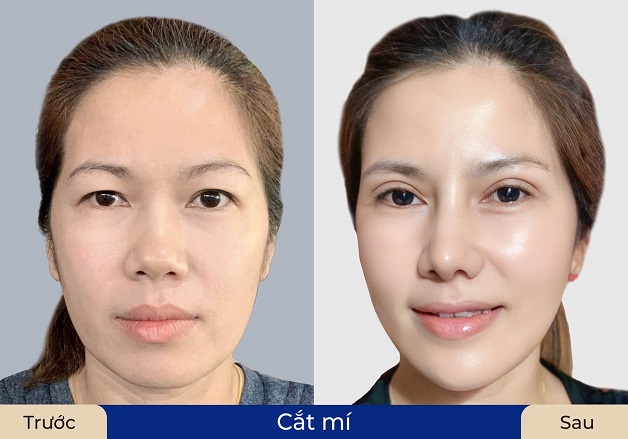 Chi phí cắt mí tại Đà Nẵng rất đa dạng, tùy thuộc vào công nghệ áp dụng