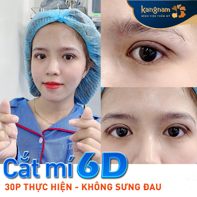 Cắt mí 6D tạo nếp mí mới siêu mảnh, không sưng, không đau