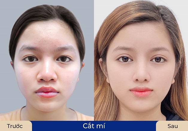Cắt mí công nghệ mới sở hữu nhiều ưu điểm vượt trội