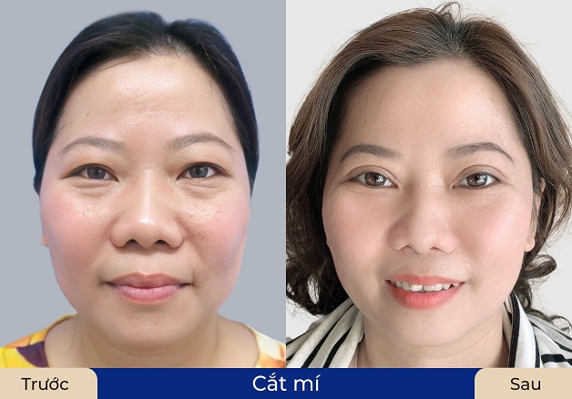 Cắt mí khi về già nếu đảm bảo thực hiện đúng kỹ thuật sẽ không gây biến chứng, rủi ro