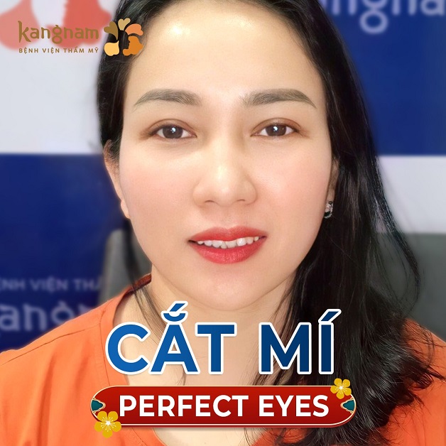 Cắt mí Perfect Eyes là công nghệ tiên tiến tại Kangnam Cần Thơ